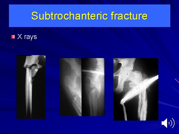 Subtrochanteric fracture X rays 
