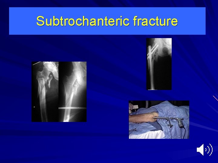 Subtrochanteric fracture 