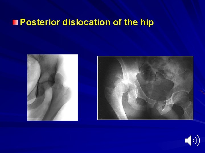 Posterior dislocation of the hip 