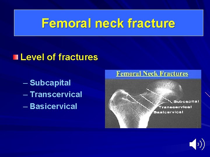Femoral neck fracture Level of fractures – Subcapital – Transcervical – Basicervical 