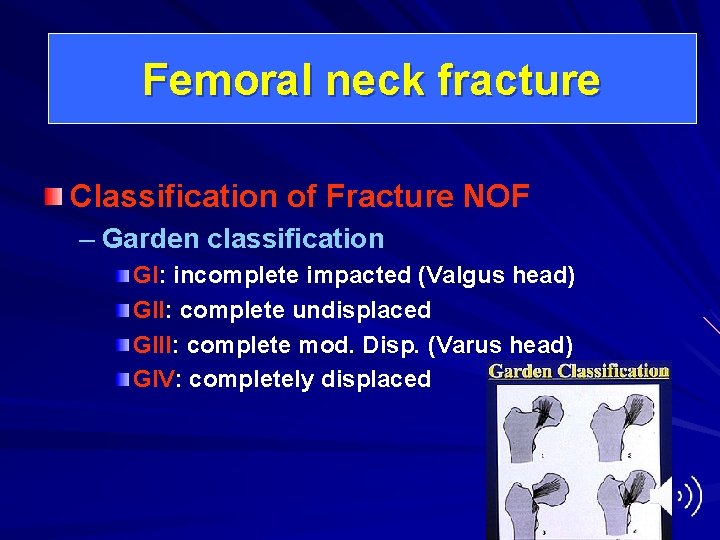 Femoral neck fracture Classification of Fracture NOF – Garden classification GI: incomplete impacted (Valgus