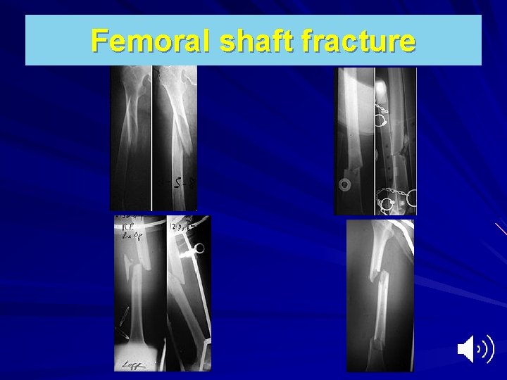 Femoral shaft fracture 