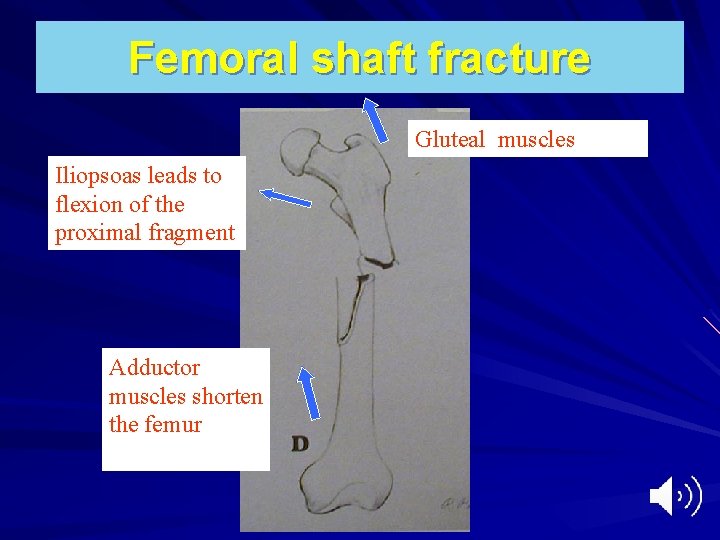 Femoral shaft fracture Gluteal muscles Iliopsoas leads to flexion of the proximal fragment Adductor