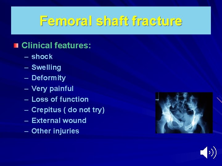 Femoral shaft fracture Clinical features: – – – – shock Swelling Deformity Very painful