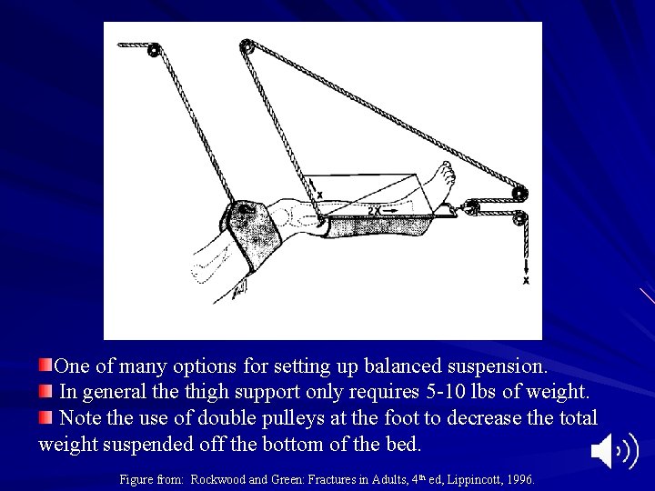One of many options for setting up balanced suspension. In general the thigh support