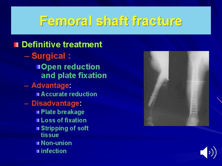 Femoral shaft fracture Definitive treatment – Surgical : Open reduction and plate fixation –