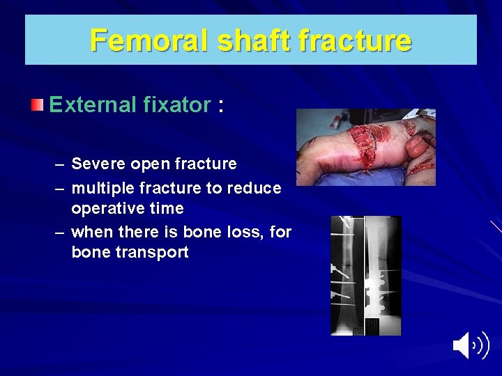 Femoral shaft fracture External fixator : – Severe open fracture – multiple fracture to