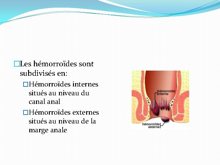 �Les hémorroïdes sont subdivisés en: �Hémorroïdes internes situés au niveau du canal �Hémorroïdes externes