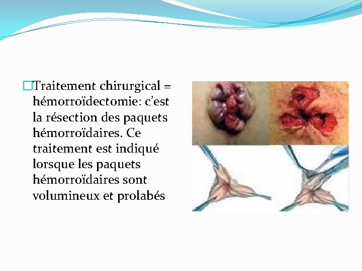 �Traitement chirurgical = hémorroïdectomie: c’est la résection des paquets hémorroïdaires. Ce traitement est indiqué