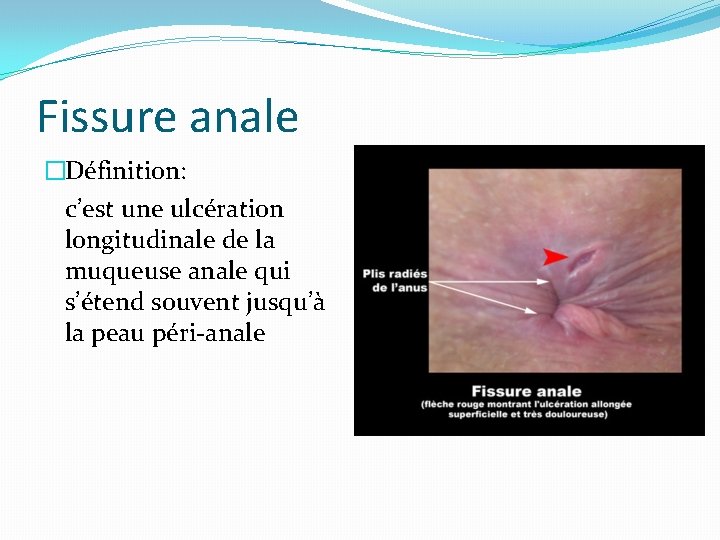 Fissure anale �Définition: c’est une ulcération longitudinale de la muqueuse anale qui s’étend souvent