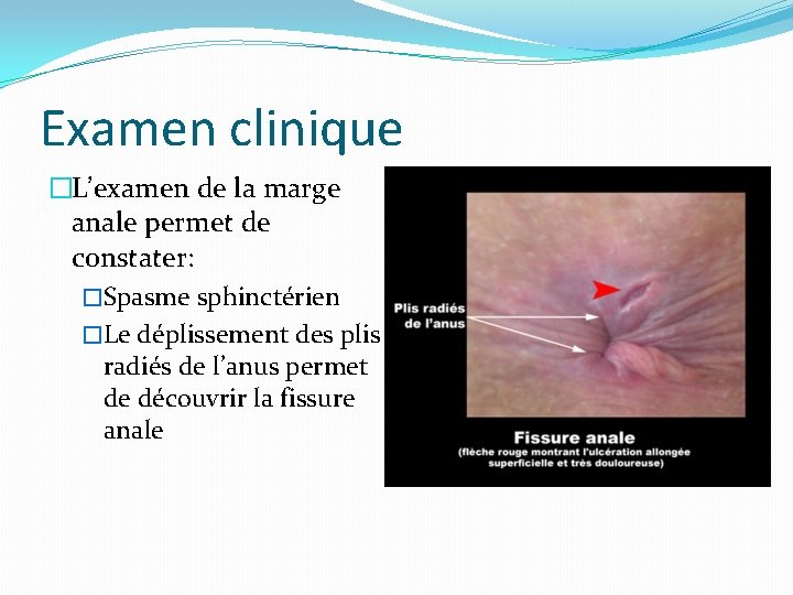 Examen clinique �L’examen de la marge anale permet de constater: �Spasme sphinctérien �Le déplissement