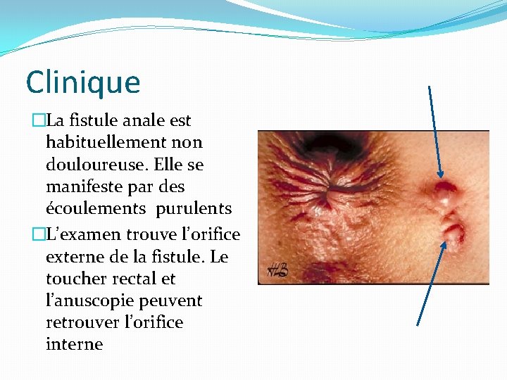 Clinique �La fistule anale est habituellement non douloureuse. Elle se manifeste par des écoulements