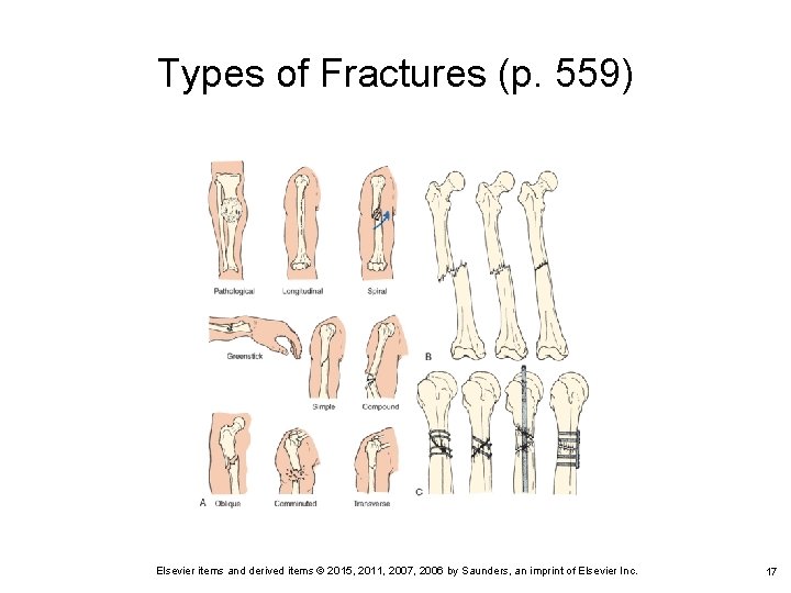 Types of Fractures (p. 559) Elsevier items and derived items © 2015, 2011, 2007,