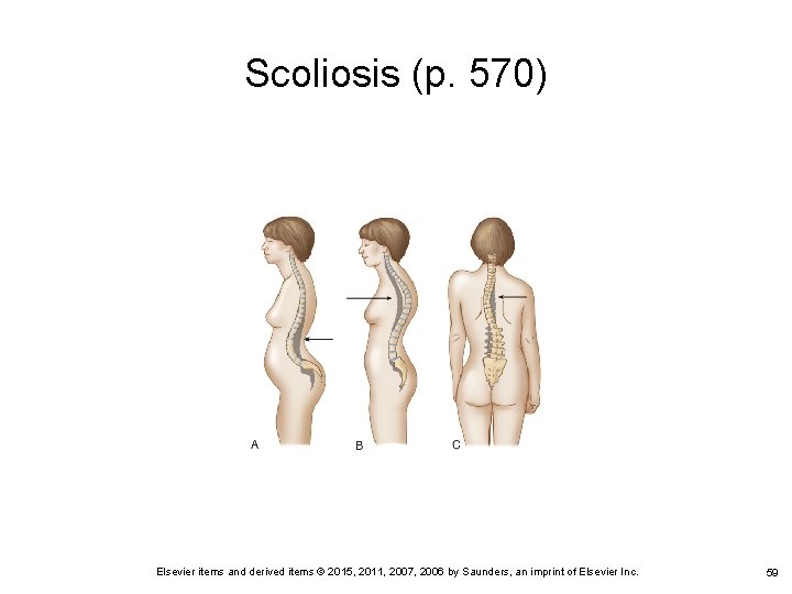 Scoliosis (p. 570) Elsevier items and derived items © 2015, 2011, 2007, 2006 by