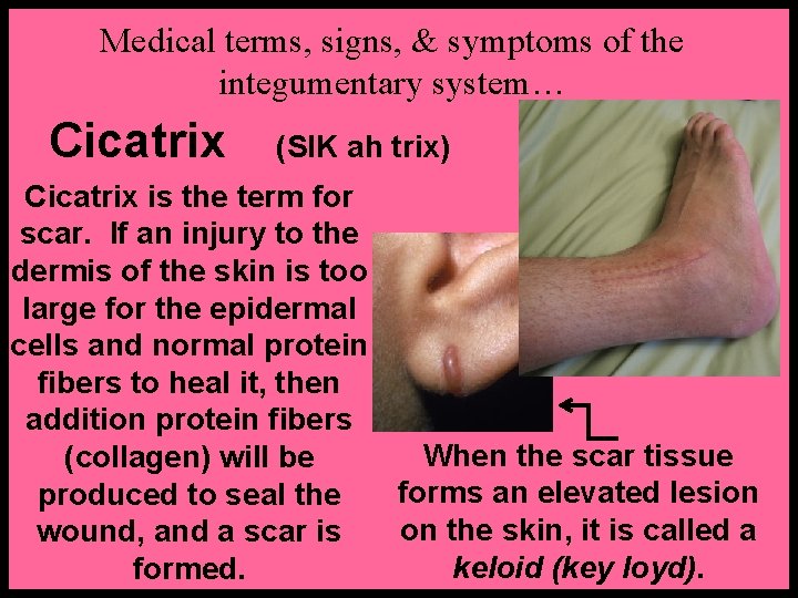 Medical terms, signs, & symptoms of the integumentary system… Cicatrix (SIK ah trix) Cicatrix
