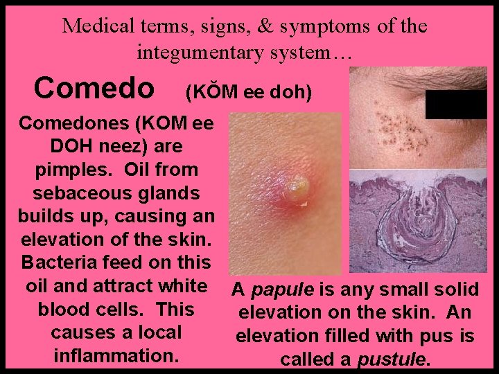 Medical terms, signs, & symptoms of the integumentary system… Comedo (KŎM ee doh) Comedones