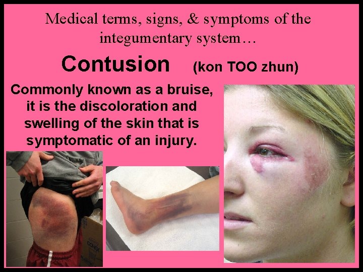 Medical terms, signs, & symptoms of the integumentary system… Contusion (kon TOO zhun) Commonly