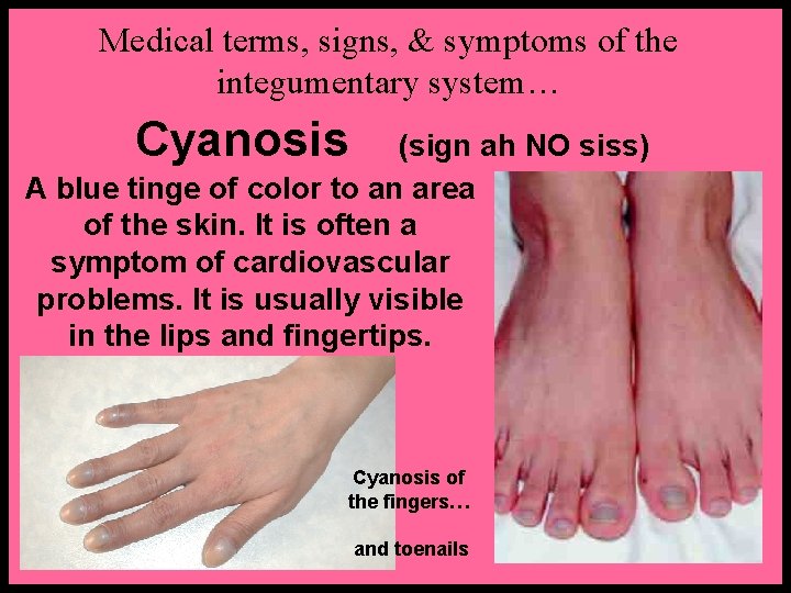Medical terms, signs, & symptoms of the integumentary system… Cyanosis (sign ah NO siss)