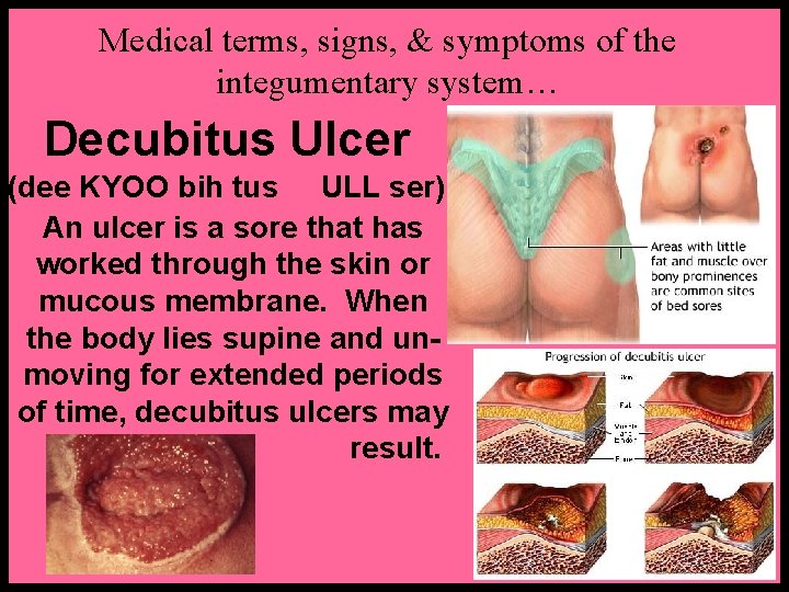 Medical terms, signs, & symptoms of the integumentary system… Decubitus Ulcer (dee KYOO bih