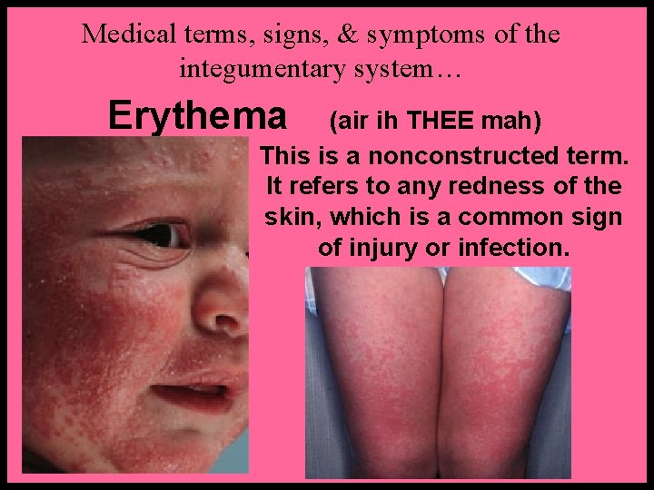 Medical terms, signs, & symptoms of the integumentary system… Erythema (air ih THEE mah)