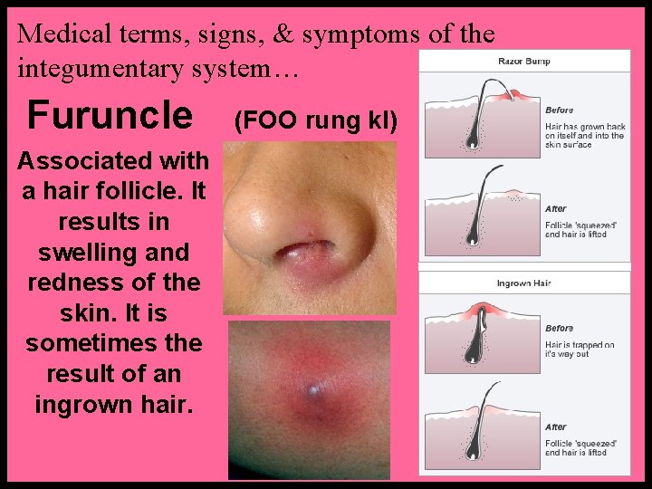 Medical terms, signs, & symptoms of the integumentary system… Furuncle Associated with a hair