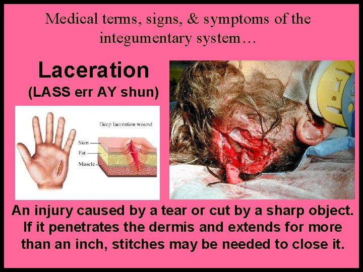 Medical terms, signs, & symptoms of the integumentary system… Laceration (LASS err AY shun)