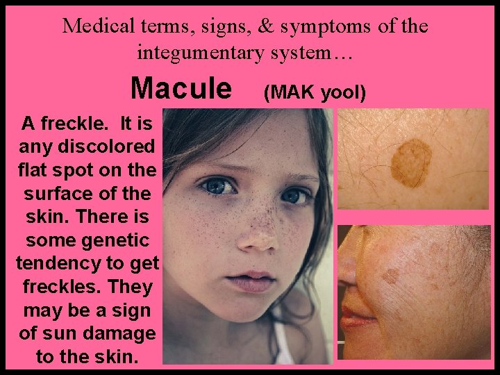 Medical terms, signs, & symptoms of the integumentary system… Macule A freckle. It is