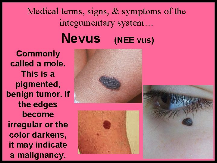 Medical terms, signs, & symptoms of the integumentary system… Nevus Commonly called a mole.