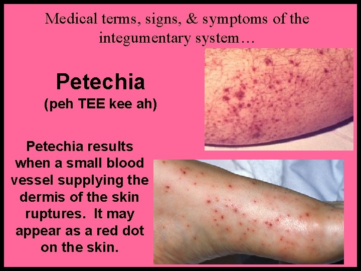 Medical terms, signs, & symptoms of the integumentary system… Petechia (peh TEE kee ah)