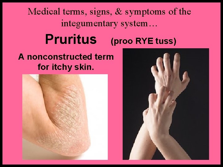 Medical terms, signs, & symptoms of the integumentary system… Pruritus (proo RYE tuss) A