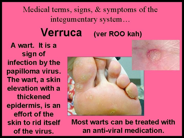 Medical terms, signs, & symptoms of the integumentary system… Verruca A wart. It is