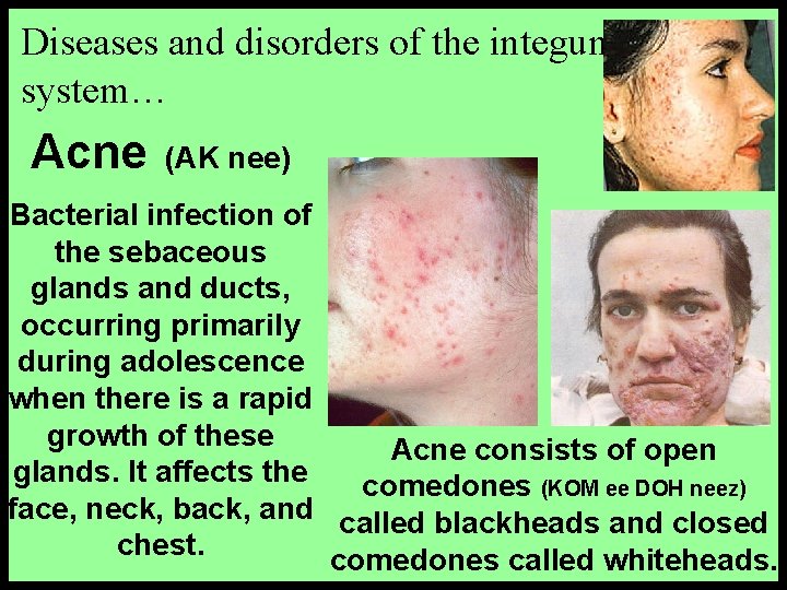 Diseases and disorders of the integumentary system… Acne (AK nee) Bacterial infection of the