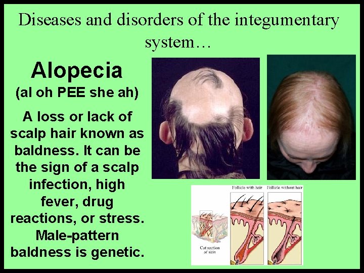 Diseases and disorders of the integumentary system… Alopecia (al oh PEE she ah) A