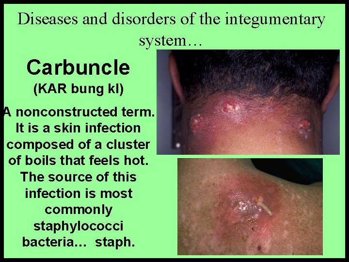Diseases and disorders of the integumentary system… Carbuncle (KAR bung kl) A nonconstructed term.
