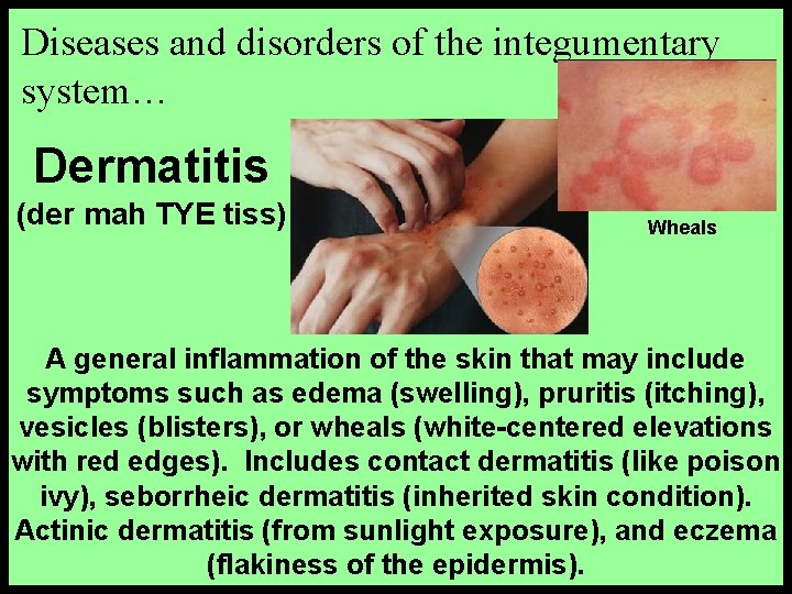 Diseases and disorders of the integumentary system… Dermatitis (der mah TYE tiss) Wheals A