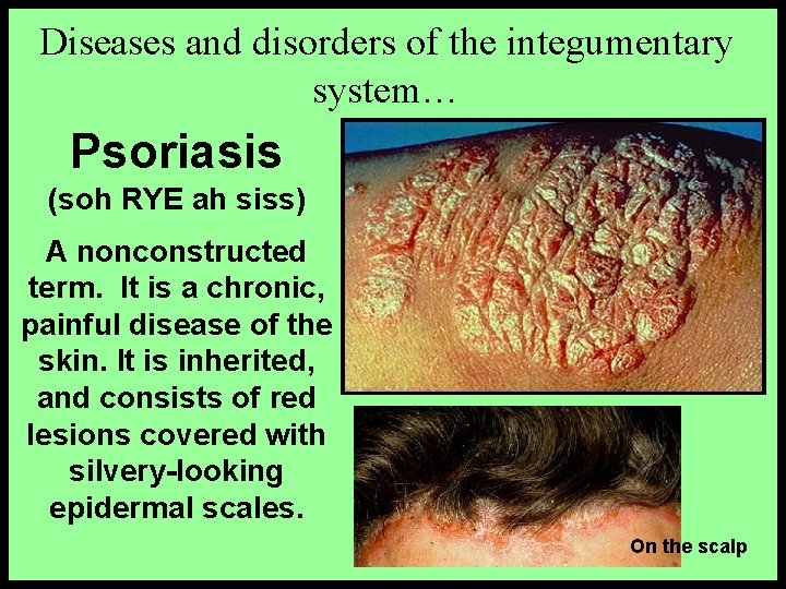 Diseases and disorders of the integumentary system… Psoriasis (soh RYE ah siss) A nonconstructed