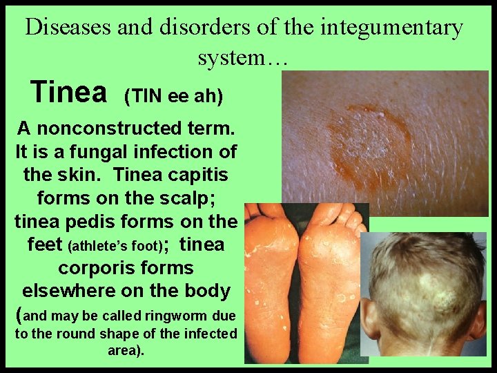Diseases and disorders of the integumentary system… Tinea (TIN ee ah) A nonconstructed term.