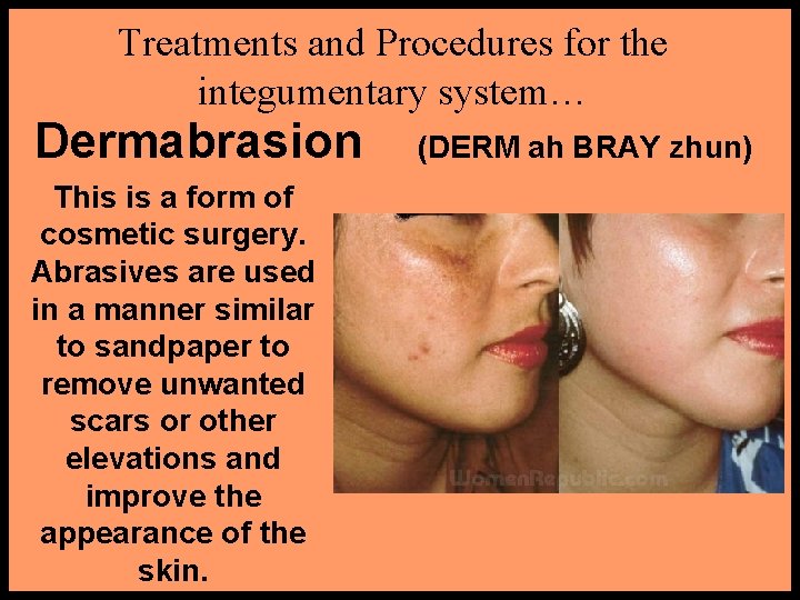 Treatments and Procedures for the integumentary system… Dermabrasion This is a form of cosmetic
