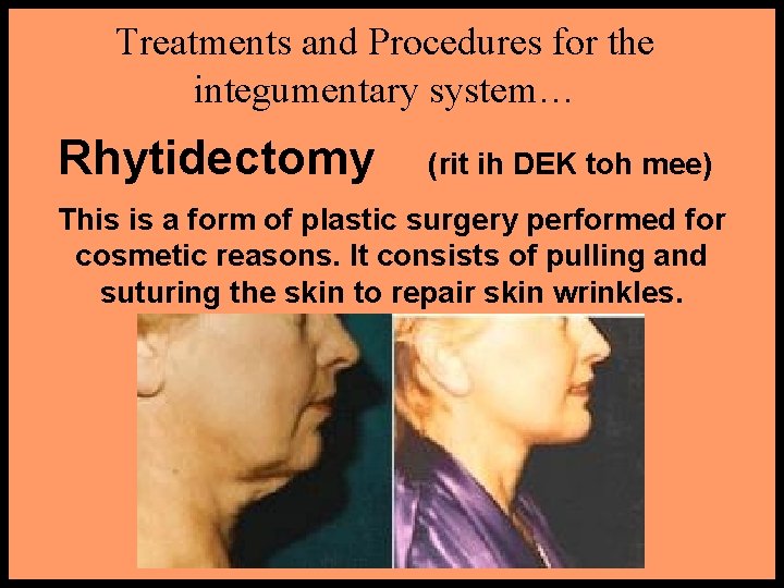 Treatments and Procedures for the integumentary system… Rhytidectomy (rit ih DEK toh mee) This