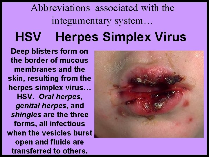 Abbreviations associated with the integumentary system… HSV Herpes Simplex Virus Deep blisters form on