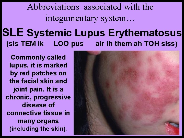 Abbreviations associated with the integumentary system… SLE Systemic Lupus Erythematosus (sis TEM ik LOO