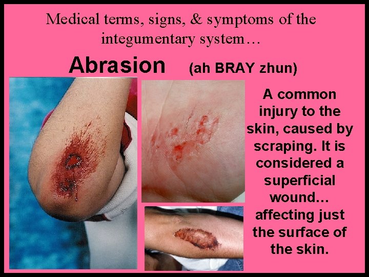 Medical terms, signs, & symptoms of the integumentary system… Abrasion (ah BRAY zhun) A