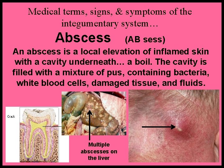 Medical terms, signs, & symptoms of the integumentary system… Abscess (AB sess) An abscess