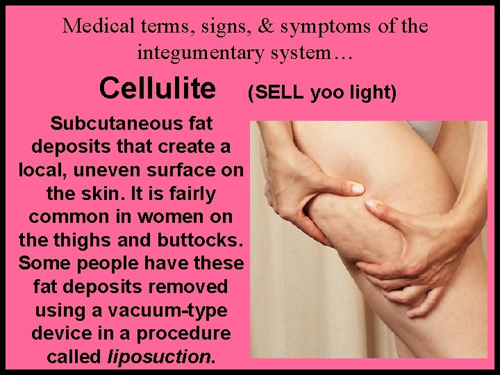 Medical terms, signs, & symptoms of the integumentary system… Cellulite Subcutaneous fat deposits that