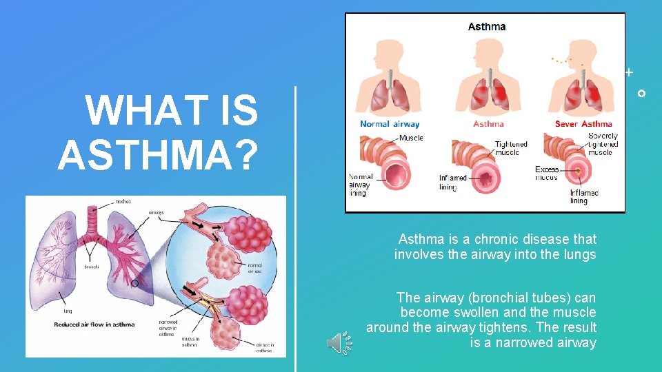 WHAT IS ASTHMA? Asthma is a chronic disease that involves the airway into the