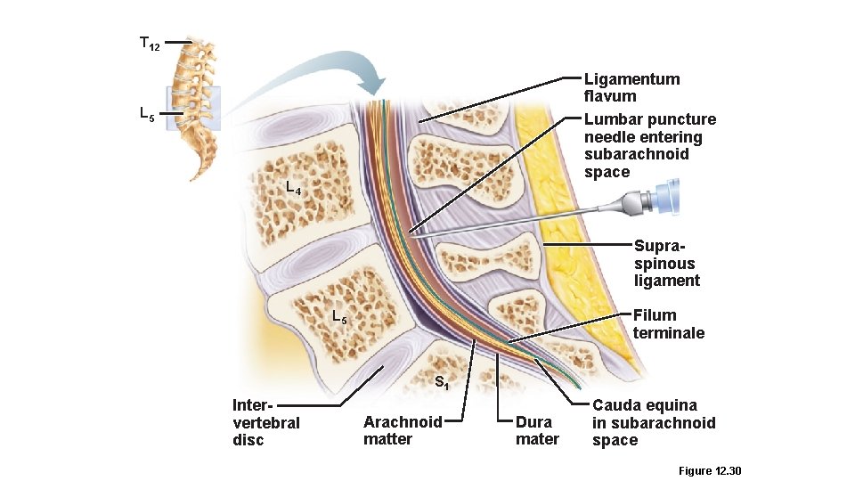 T 12 Ligamentum flavum Lumbar puncture needle entering subarachnoid space L 5 L 4