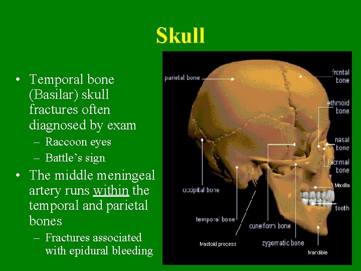 Skull • Temporal bone (Basilar) skull fractures often diagnosed by exam – Raccoon eyes