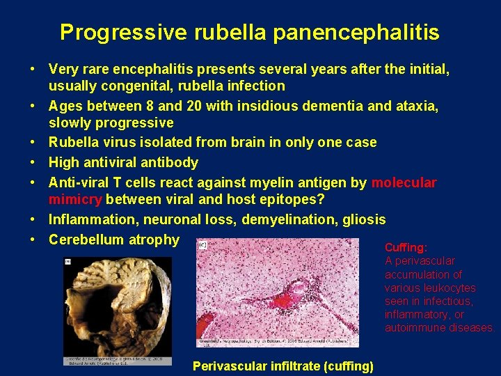 Progressive rubella panencephalitis • Very rare encephalitis presents several years after the initial, usually Progressive rubella panencephalitis • Very rare encephalitis presents several years after the initial, usually