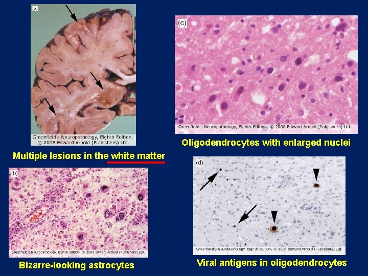 Oligodendrocytes with enlarged nuclei Multiple lesions in the white matter Bizarre-looking astrocytes Viral antigens Oligodendrocytes with enlarged nuclei Multiple lesions in the white matter Bizarre-looking astrocytes Viral antigens
