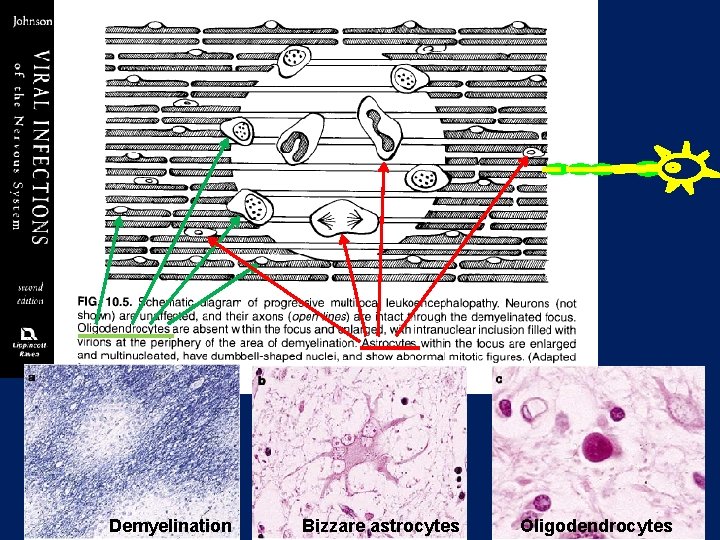 Demyelination Bizzare astrocytes Oligodendrocytes Demyelination Bizzare astrocytes Oligodendrocytes